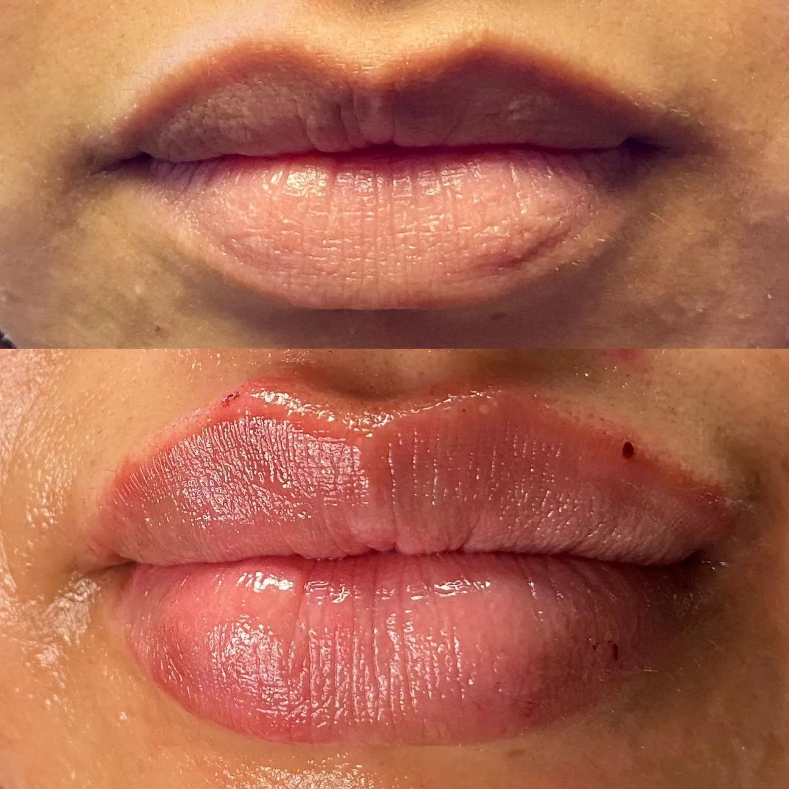 Comparación de labios: antes arriba, inmediatamente después del tratamiento abajo