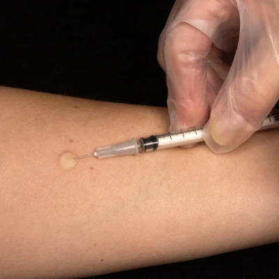 Prueba cutánea de tuberculina